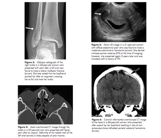 Illustration for article titled Researchers Study How X-Rays Can Be a Flag for Domestic Violence